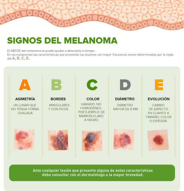La regla del ABCDE - como detectar un melanoma