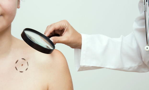 Diagnosticar cáncer de piel - Examen en la piel