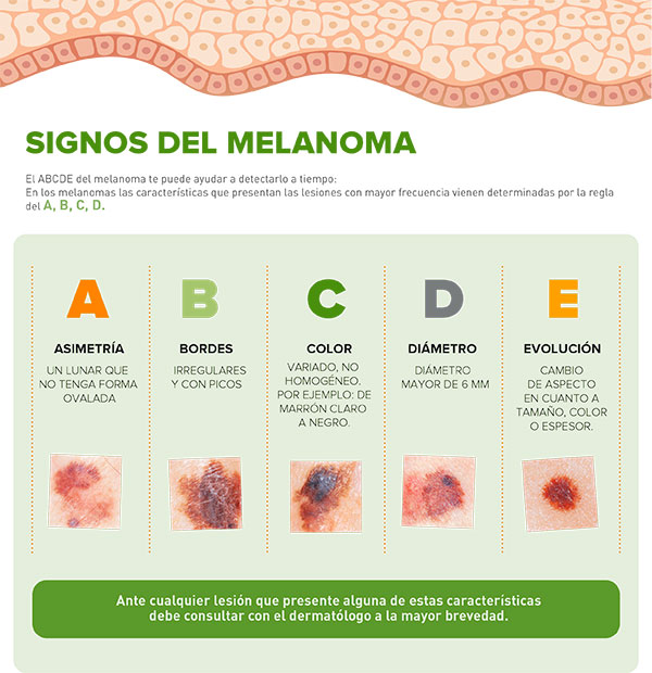Criterios ABCD del melanoma