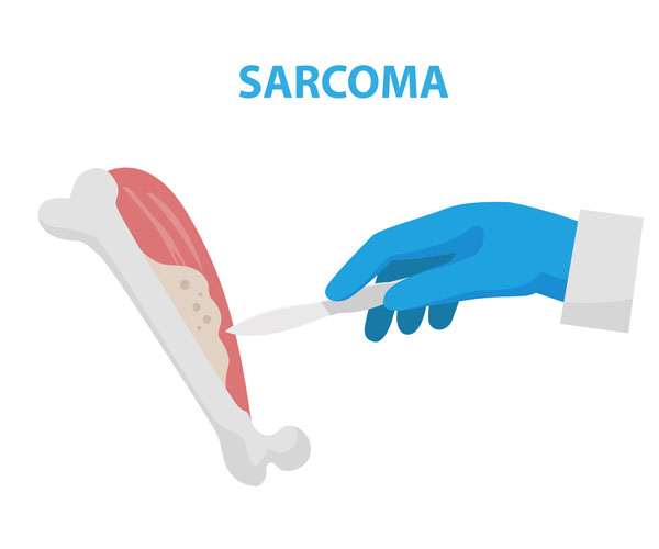 sarcoma de tejidos blandos