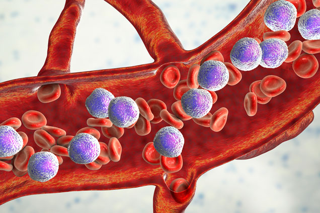 Leucemia linfoblástica linfática aguda - Síntomas, que es, tratamientos