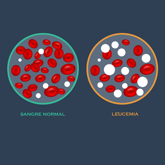 ¿Qué es la leucemia? - Diferencia entre sangre normal y con leucemia