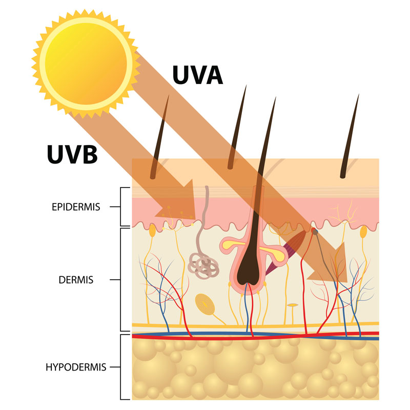Melanoma en la piel - La excesiva exposición a la luz solar afecta a la incidencia del cáncer