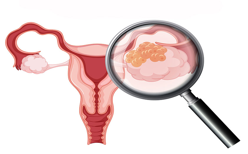 Cáncer de ovario. En esta imagen se muestra un ejemplo de la anatomía femenina